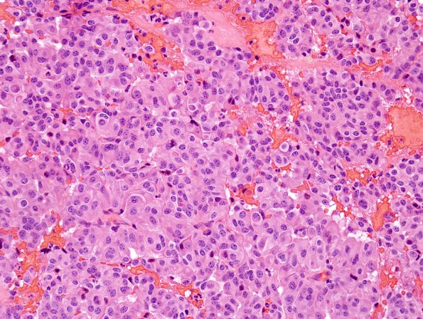 21A Pituitary Adenoma (Case 21) H&E