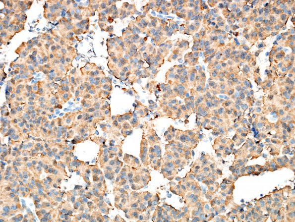 21B Pituitary Adenoma (Case 21) ACTH