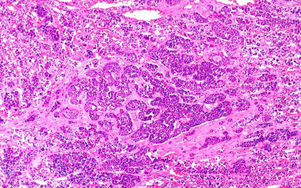 6A6 Pituitary, normal basophil invasion (Case 6) H&E 10X