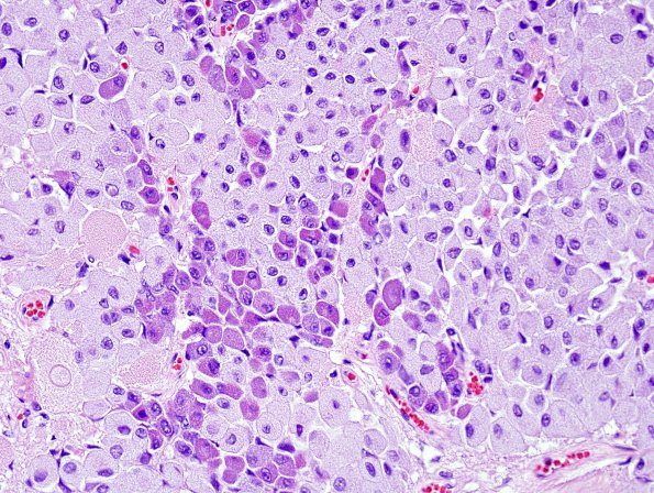 10A3 Pituitary Adenoma (Zoo Case) H&E 5