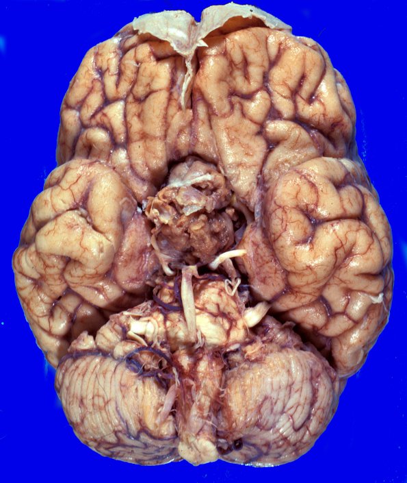 1A1 Pituitary Adenoma (Case 1) gross 1