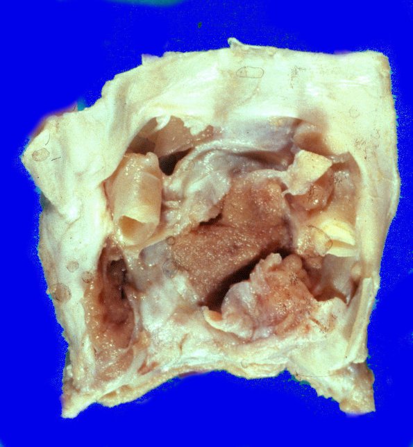 2A2 Pituitary adenoma (Case 2) 1