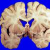 2A3 Pituitary Adenoma (Case 2)