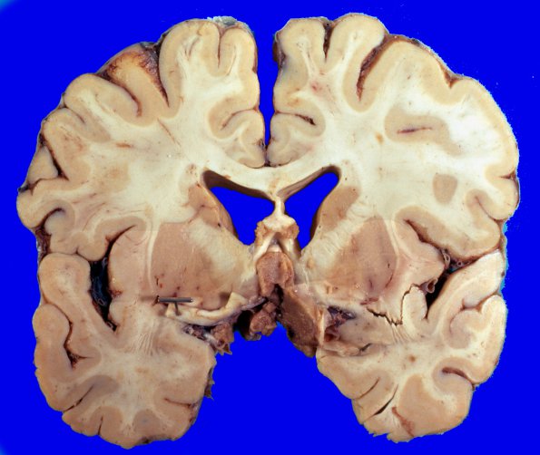 2A3 Pituitary Adenoma (Case 2)