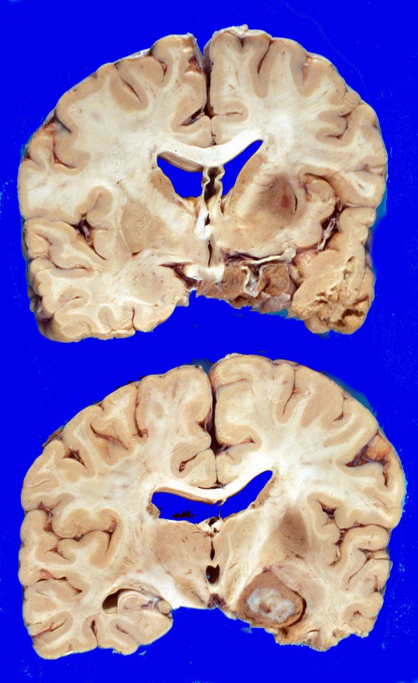 2A4 Pituitary Adenoma (Case 2) 3