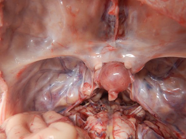 3A2 Pituitary Adenoma (Case 3) _2