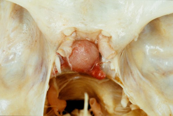 4A Pituitary adenoma (from Dr Goodwin) 2