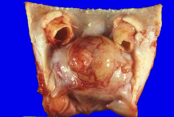 5A Pituitary adenoma (WUMS Case) 2