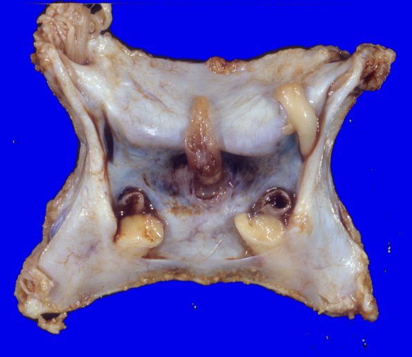 7A1 Pituitary Adenoma resection, SP Cardiac Arrest (Case 7) 1