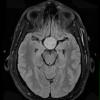 1A1 Pituitary Adenoma (Case 1) TIRM 1 - Copy