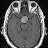 1A3 Pituitary Adenoma (Case 1) T1 W 5 - Copy