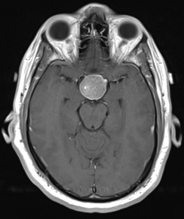 1A3 Pituitary Adenoma (Case 1) T1 W 5 - Copy