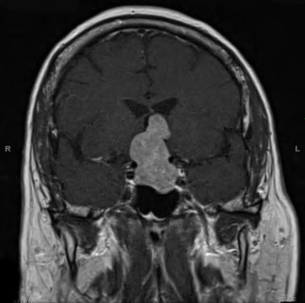 2A Pituitary Adenoma (Case 2) T1 W 1 - Copy