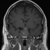 3A1 Pituitary adenoma (Case 3) T1 1 - Copy