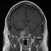 3A2 Pituitary adenoma (Case 3) T1 W 1 - Copy