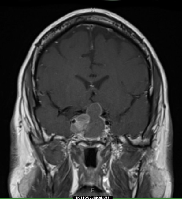 3A2 Pituitary adenoma (Case 3) T1 W 1 - Copy