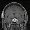 4A1 Pituitary adenoma (Case 4) T1 W 2 - Copy