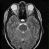 5A Pituitary Adenoma (Case 5) MRI fluid level T2 - Copy