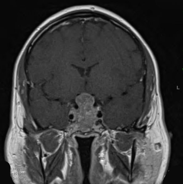 6A Pituitary Adenoma (Case 6) T1 W 2 - Copy