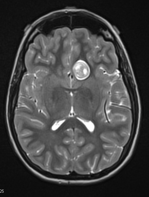 8A2 Pituitary adenoma (Case 8) T2 W 1 - Copy