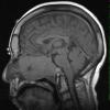 9A1 Pituitary Adenoma (Case 9) T1 1 - Copy