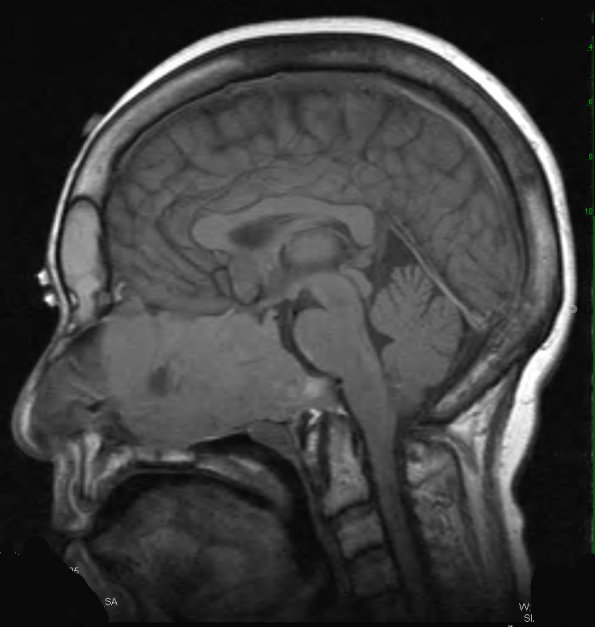 9A1 Pituitary Adenoma (Case 9) T1 1 - Copy