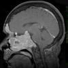 9A2 Pituitary Adenoma (Case 9) T1 W 3 - Copy