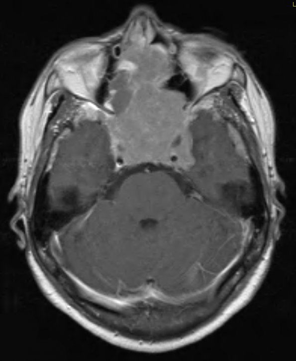 9A3 Pituitary Adenoma (Case 9) T1 W 1 - Copy