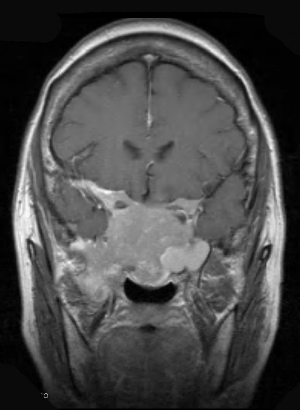 9A4 Pituitary Adenoma (Case 9) T1 W 2 - Copy