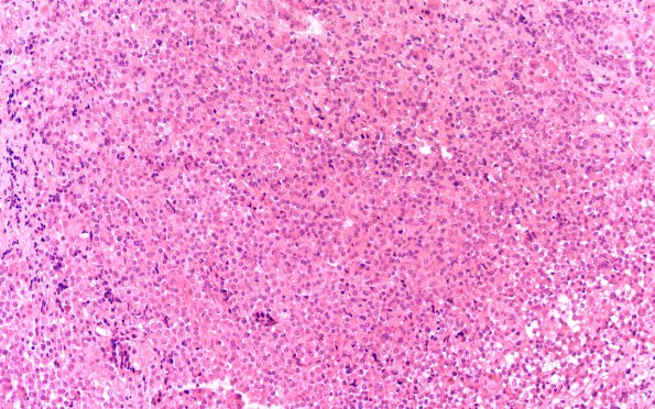 2A1 Pituitary adenoma GH FB (Case 2) H&E 20X