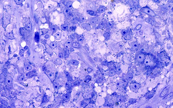 2E2 Pituitary adenoma GH FB (Case 2) PLastic 100X 5