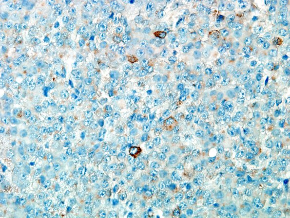 4B2 PA, sparse granulation (Case 4) GH 1.jpg