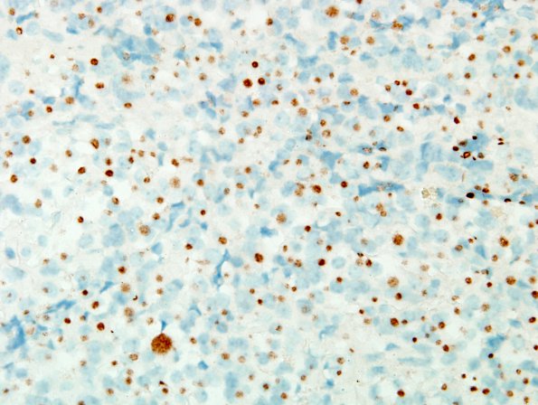 4C1 PA, sparse granulation (Case 4) CK 1.jpg