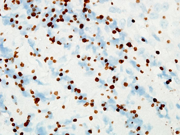 4C2 PA, sparse granulation (Case 4) CK 1.jpg