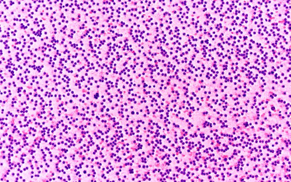 6A1 PA (Case 6) H&E smear 20X