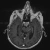 1A2 Spindle cell Oncocytoma (Case 1) T1W A - Copy