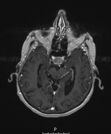 1A2 Spindle cell Oncocytoma (Case 1) T1W A - Copy