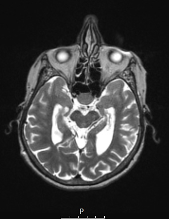 1A3 Spindle cell Oncocytoma (Case 1) T2 A - Copy