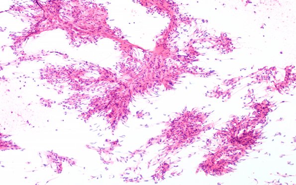 1B Spindle cell Oncocytoma (Case 1) H&E smear 1