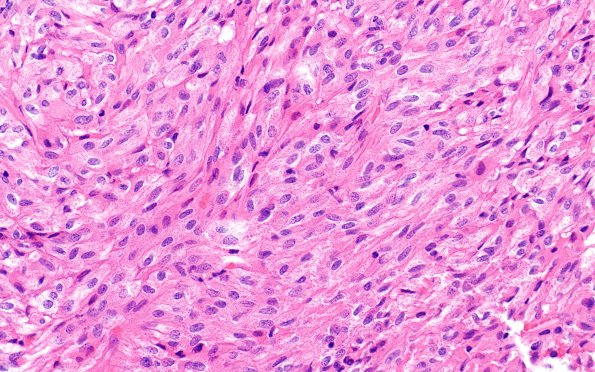 1C5 Spindle cell Oncocytoma (NP19-71) H&E 5