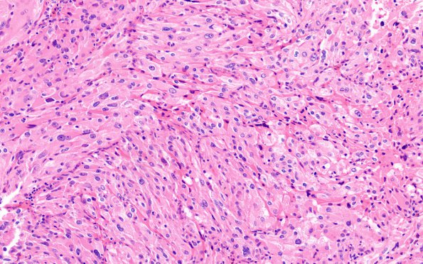 1C6 Spindle cell Oncocytoma (Case 1) H&E 11