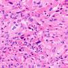 1C7 Spindle cell Oncocytoma (Case 1) H&E 8