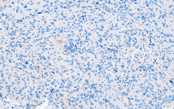 1E1 Spindle cell Oncocytoma (Case 1) GFAP 1