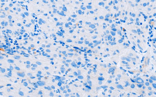 1E2 Spindle cell Oncocytoma (Case 1) GFAP 2