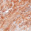 1F1 Spindle cell Oncocytoma (Case 1) S100 2