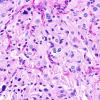 1G Spindle cell Oncocytoma (Case 1) PAS 1