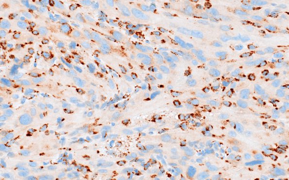 1I Spindle cell Oncocytoma (Case 1) CD68 1