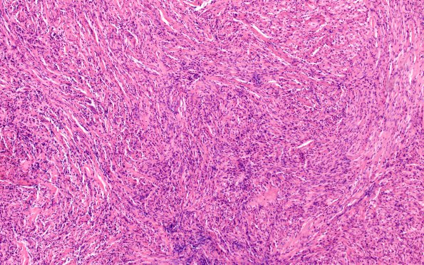 2A1 Spindle cell Oncocytoma (Case 2) H&E 4