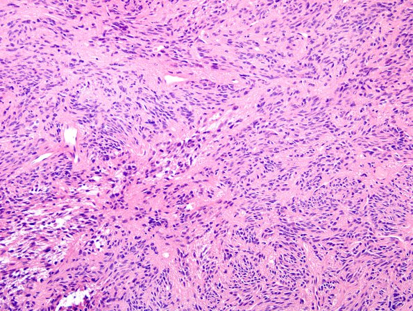 3A1 Spindle cell oncocytoma (Case 3) H&E 2