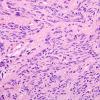 3A2 Spindle cell oncocytoma (Case 3) H&E 1